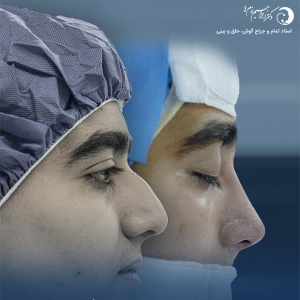 جراحی-بینی-225
