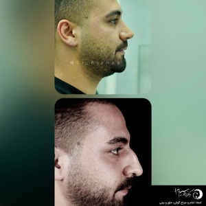 rhinoplasty-300