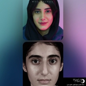 rhinoplasty-301