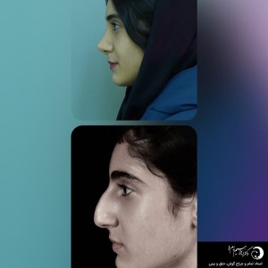 rhinoplasty-302