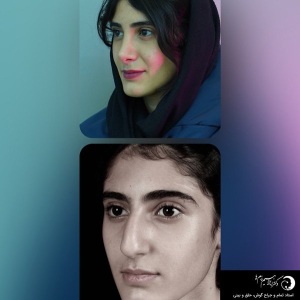 rhinoplasty-303