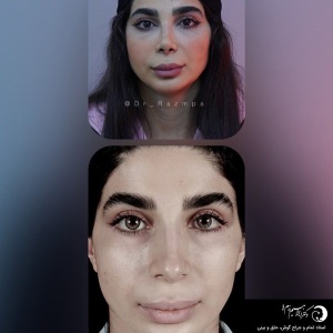 rhinoplasty-305