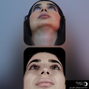 rhinoplasty-306