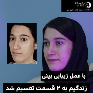 rhinoplasty-307