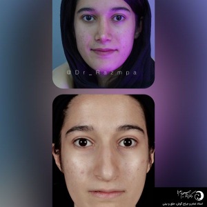 rhinoplasty-308