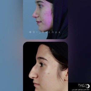 rhinoplasty-309