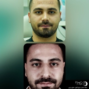 rhinoplasty299