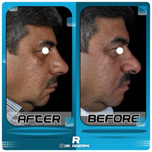 عکس قبل و بعد جراحی بینی گوشتی
