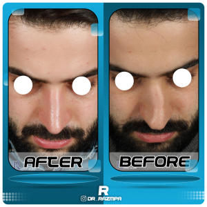 قبل و بعد جراحی بینی استخوانی
