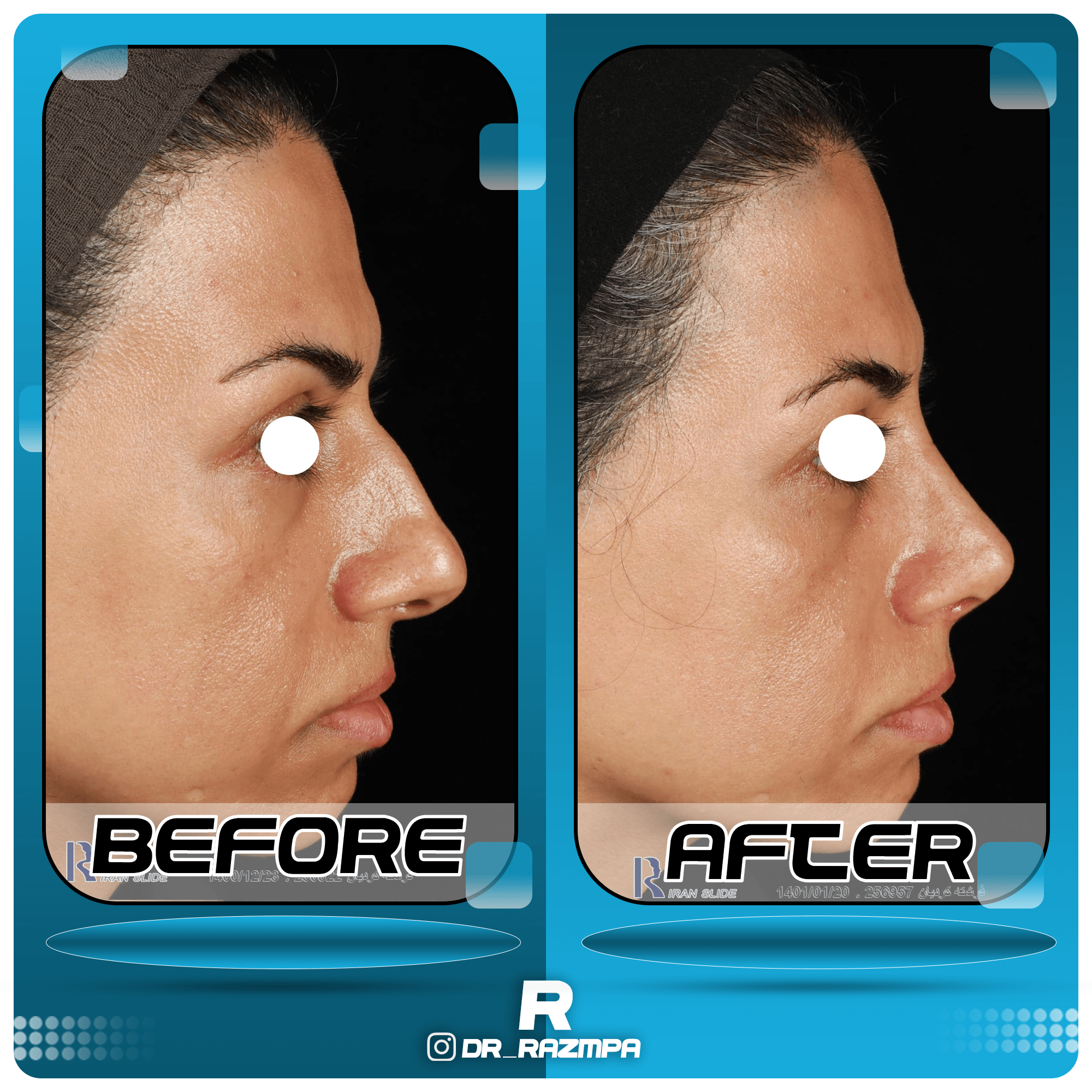 عکس قبل و بعد جراحی بینی استخوانی