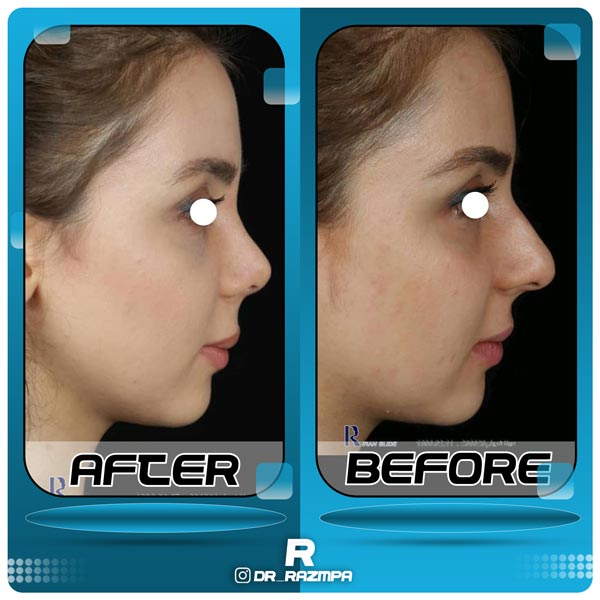 جراحی بینی نیمه فانتزی