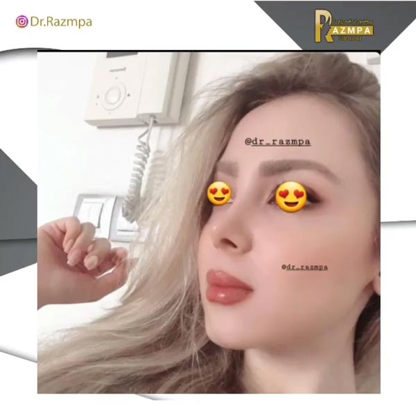 عکس نمونه کار جراحی بینی فانتزی