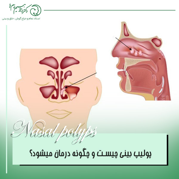 پولیپ بینی چیست؟ آیا پولیپ بینی درمان قطعی دارد؟