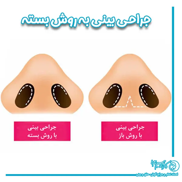 جراحی بینی بسته