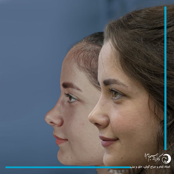 جراحی بینی نیمه فانتزی + دکتر ابراهیم رزم پ