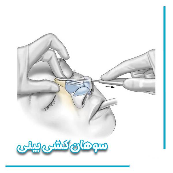 سوهان کشی بینی