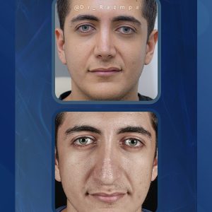 عکس نمونه کار بهترین جراح بینی - دکتر ابراهیم رزم پا- razmpa.com
