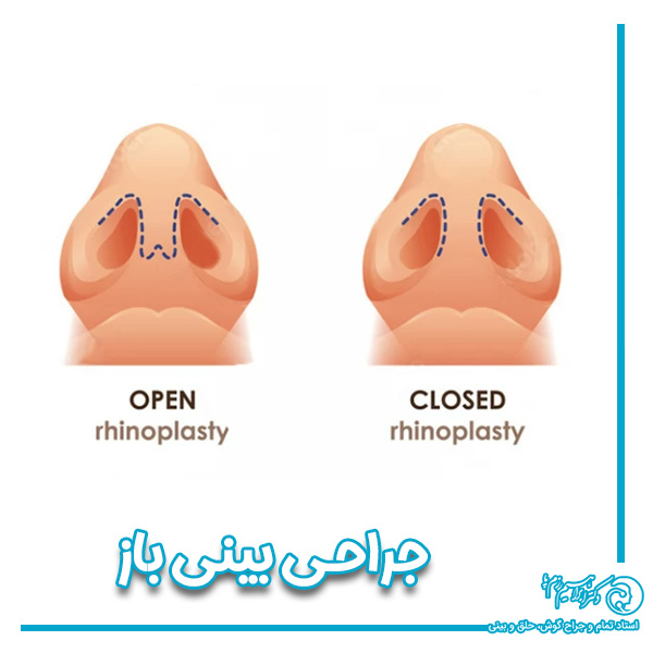 جراحی بینی باز https://razmpa.com/