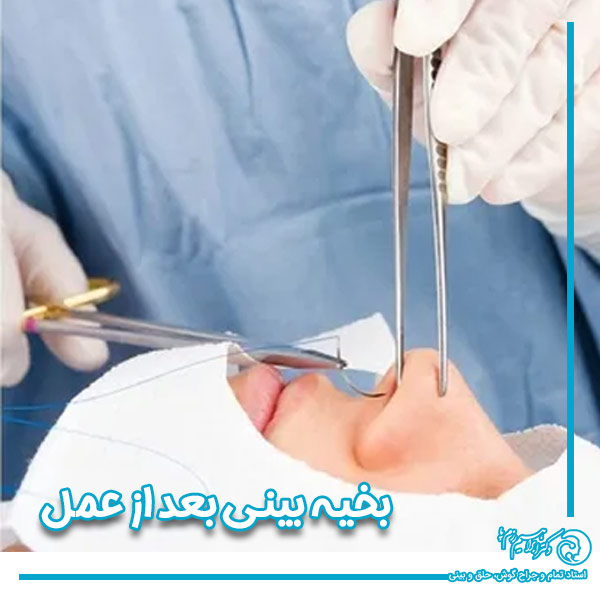 بخیه بینی بعد از عمل razmpa.com