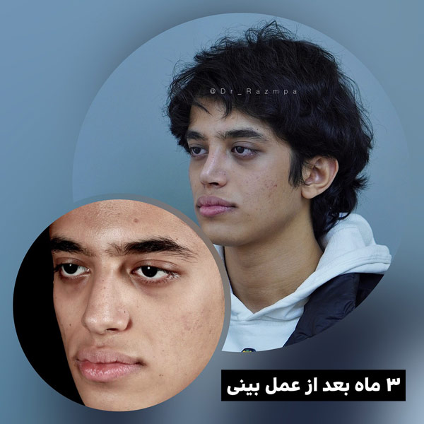 بخیه بینی بعد از عمل razmpa.com