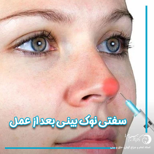 سفتی نوک بینی بعد از عمل