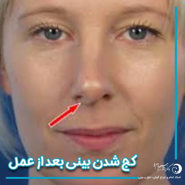 کج شدن بینی بعد از عمل