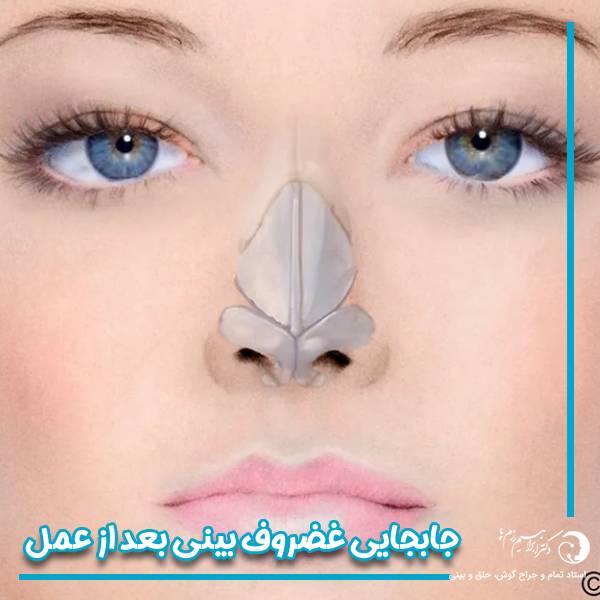جابجایی غضروف بینی بعد از عمل