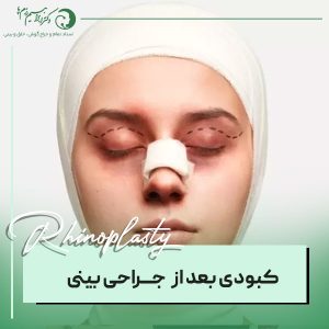 کبودی بعد از عمل بینی