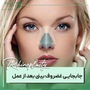 جابجایی غضروف بینی بعد از عمل