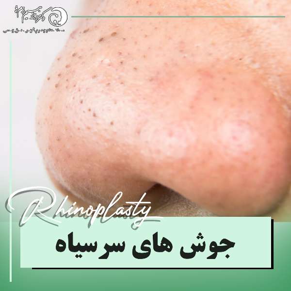 جوش های سرسیاه