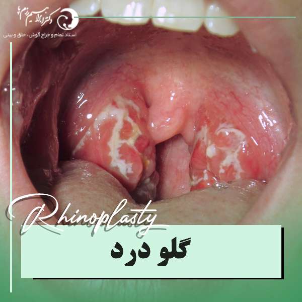 گلو درد
